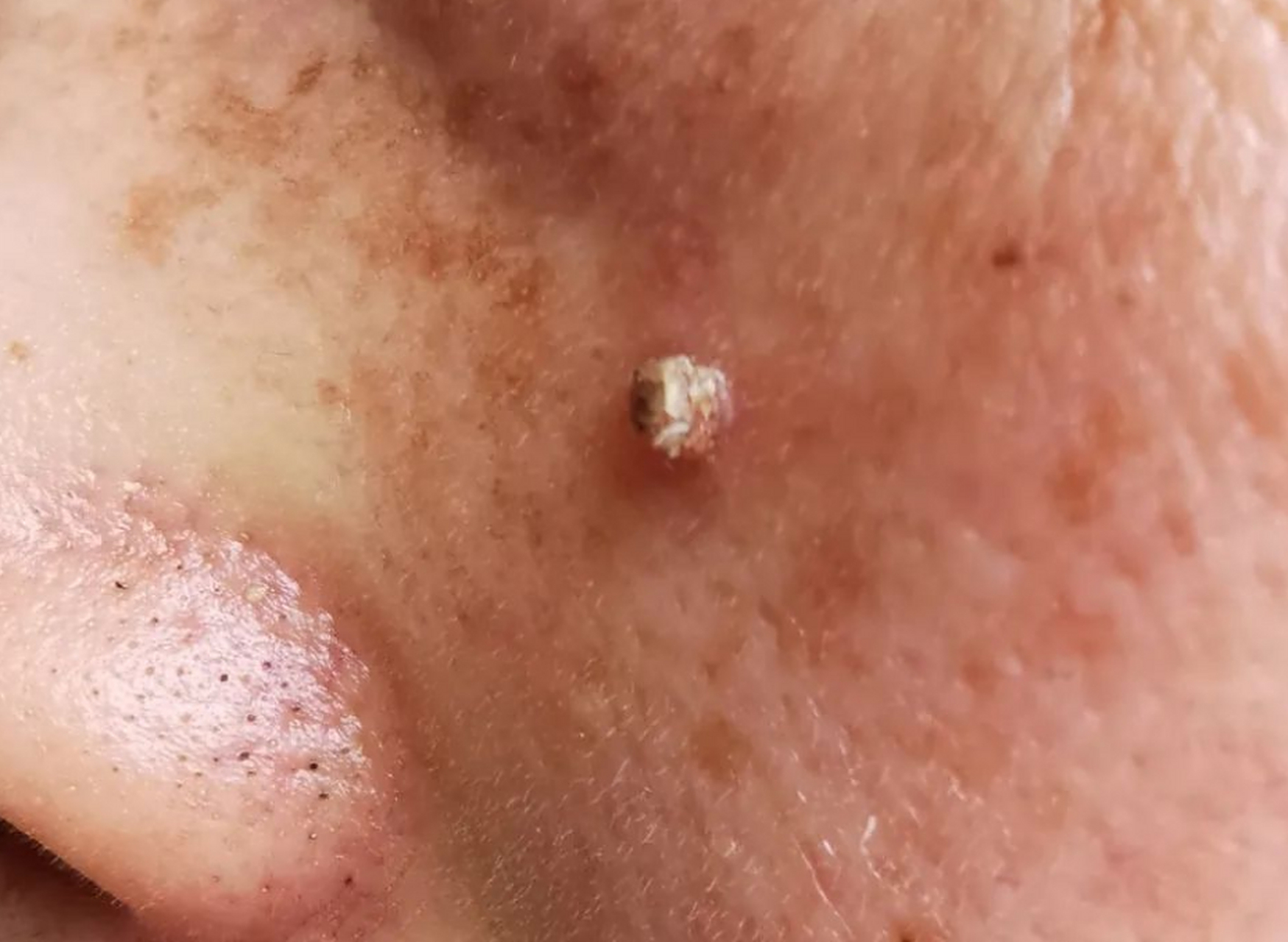 女性感染 hpv,最明显的4个征兆  1,私处皮肤出现红色丘疹或小的赘生物