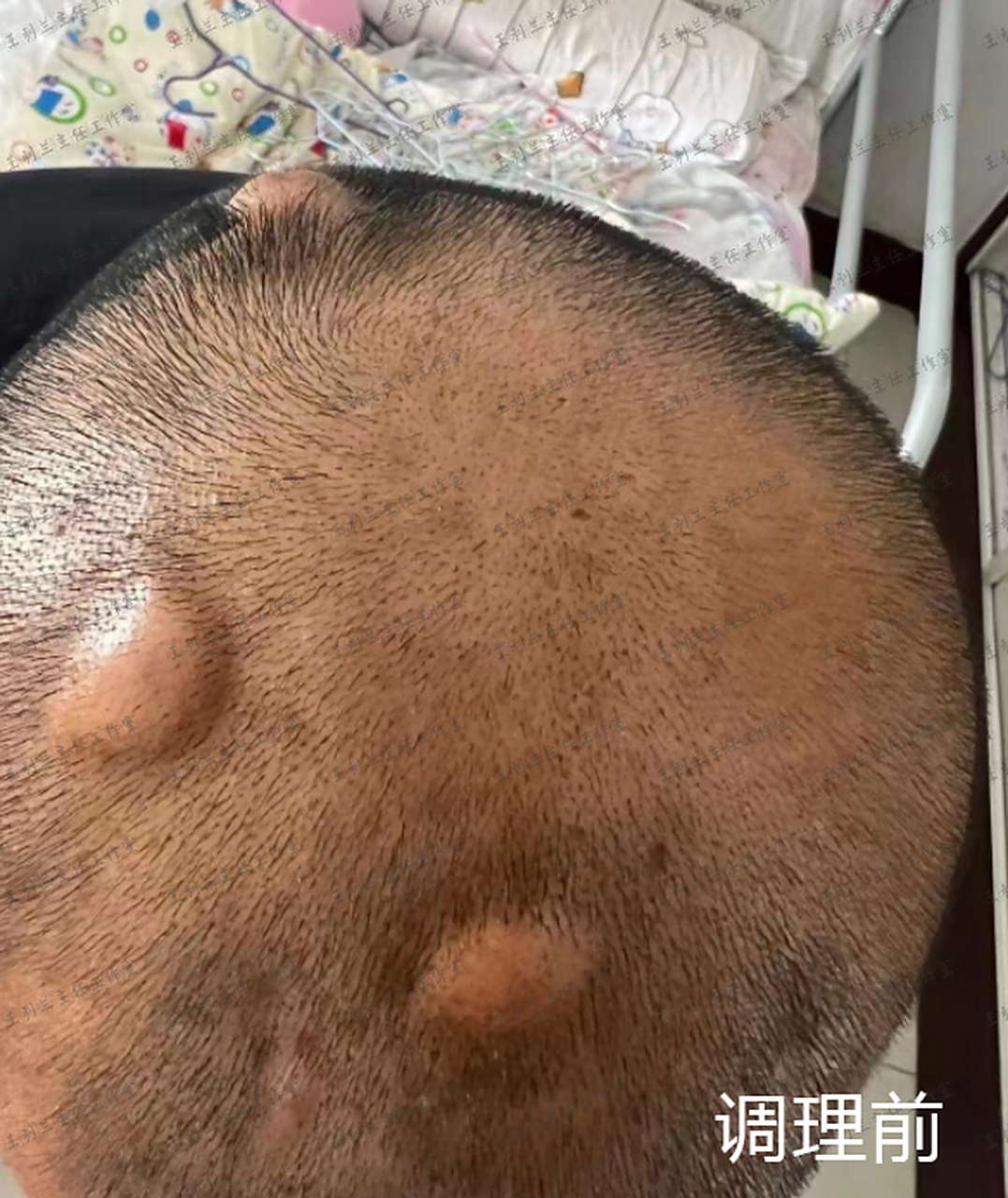 长一脑袋"鸽子蛋"大小的脓包,中医辨证,让毛囊炎无处可逃!