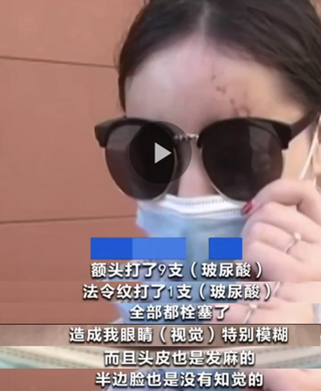 玻尿酸填充额头,法令纹,全部栓塞了!