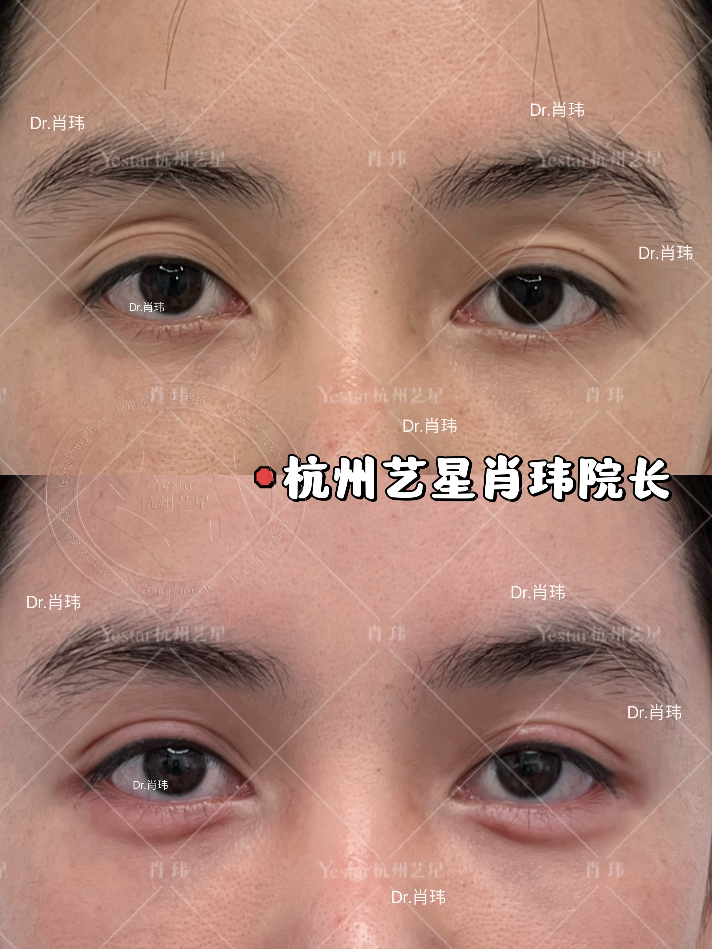 迪丽热巴轻混血眼打造 眼窝饱满双眼皮弧度流畅卧蚕甜美泪沟平整