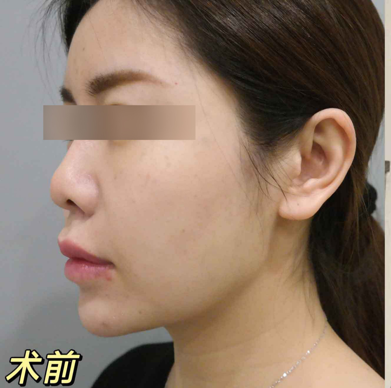 拉皮术后一定会很痛吗?