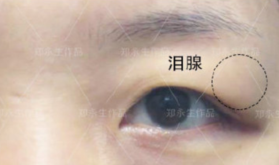 泪腺脱垂的治疗首选手术一定复位,通过手术的方法把脱垂的泪腺组织