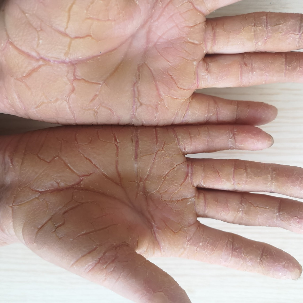 角化症是以掌跖部弥漫性或者局限性角化过度为特征的一组遗传性皮肤病