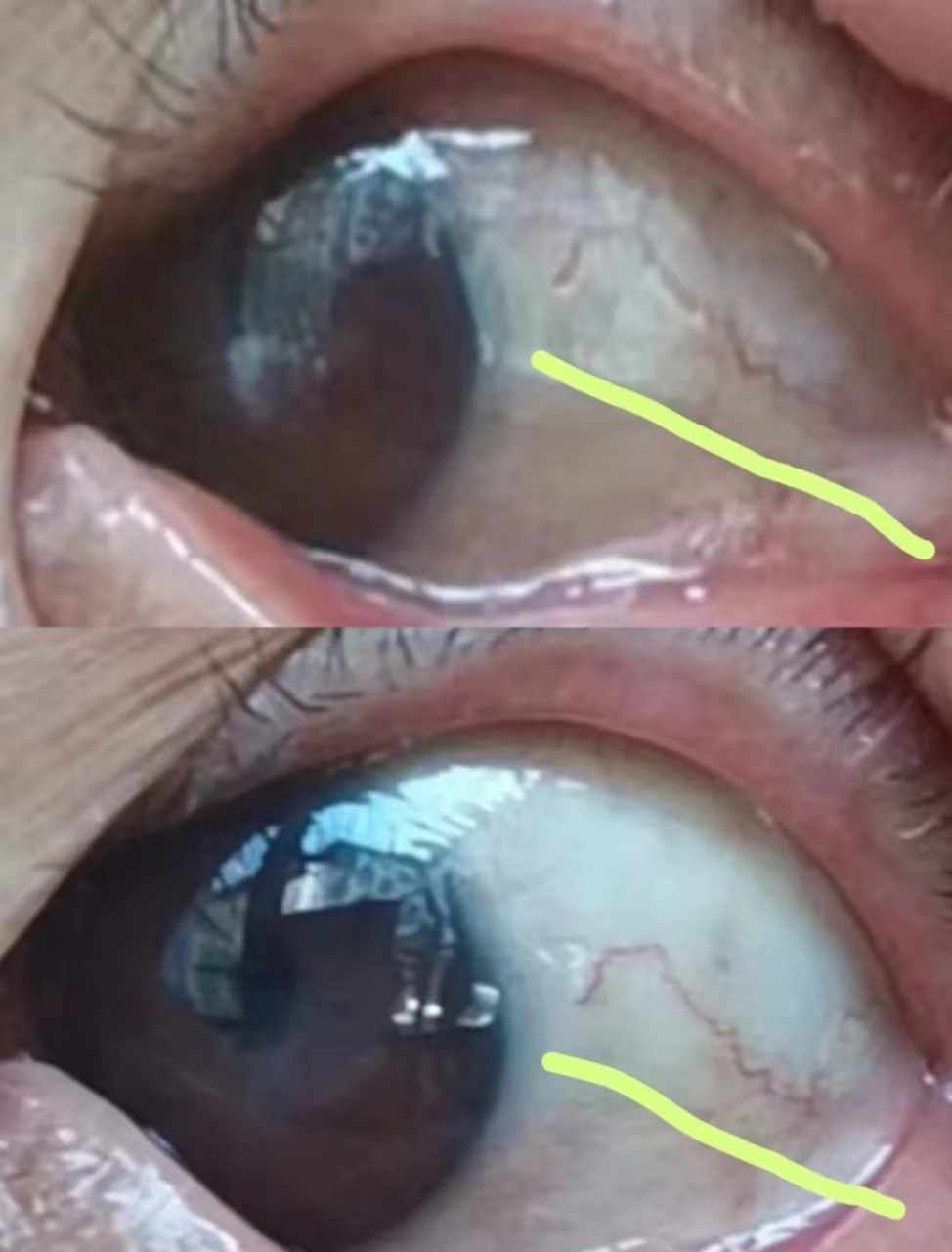 角膜炎急性发作后,有的会留下白斑,中医眼科也叫云翳.