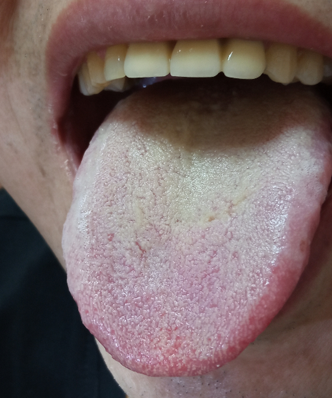 更年期每天心情烦闷,舌头火辣辣的疼,不光是更年期综合征.