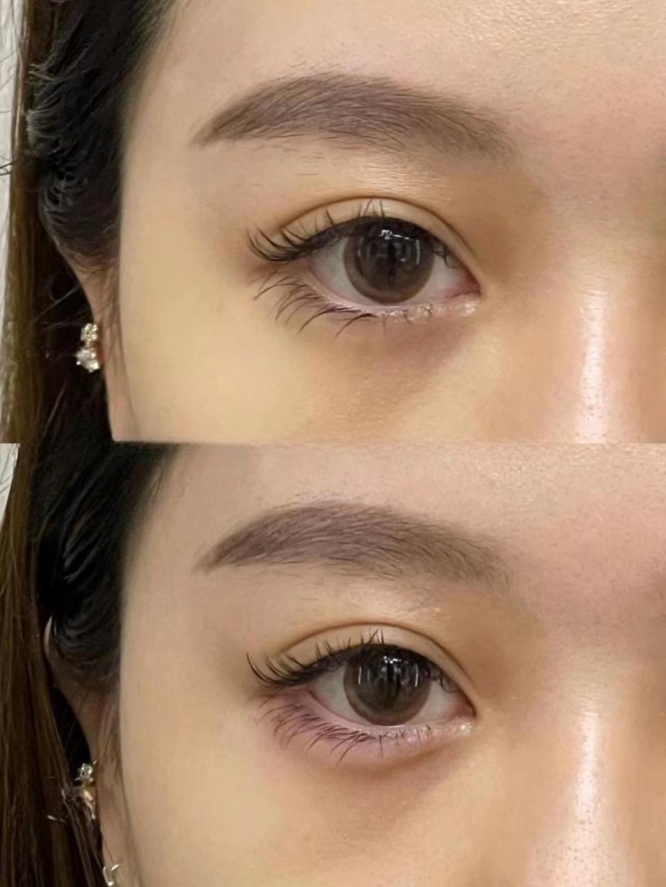 卧蚕只是案例对比#玻尿酸丰卧蚕