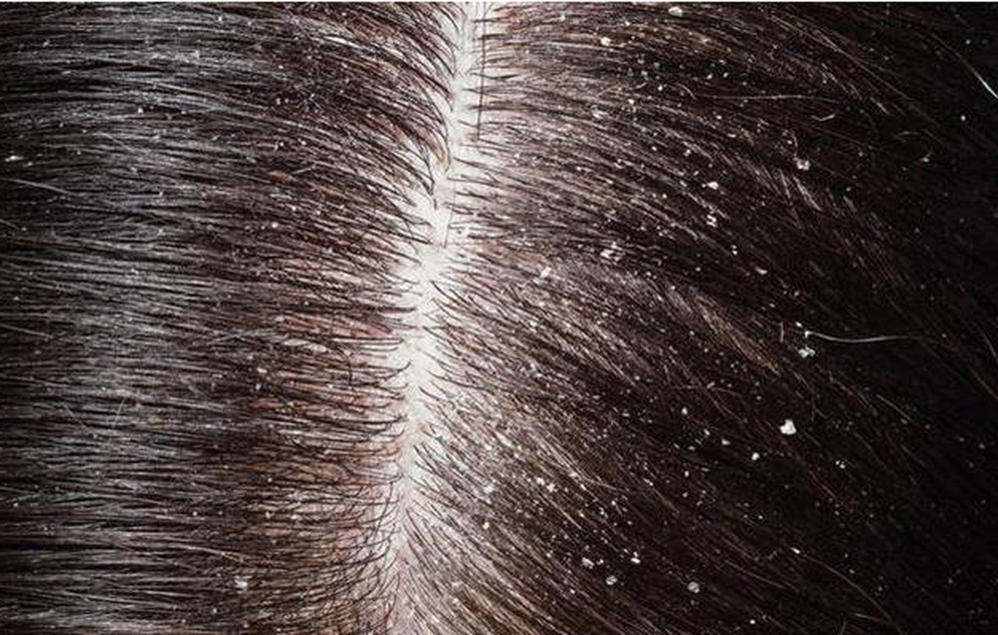 哪种洗发水对油性头皮屑和干燥头发有综合的解决方案?