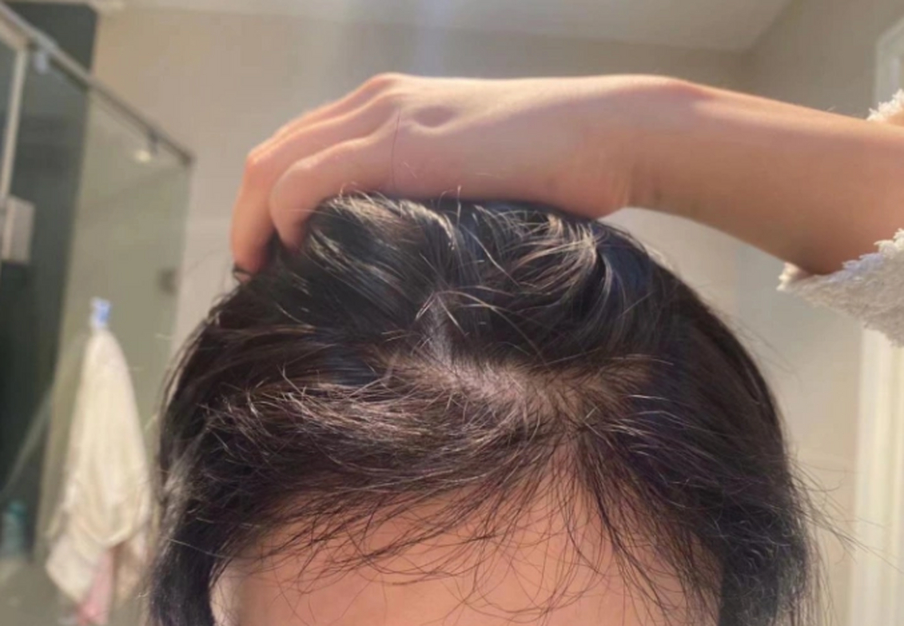 女性植发必须剃头发吗吗(女性植发要把头发全剃光吗)