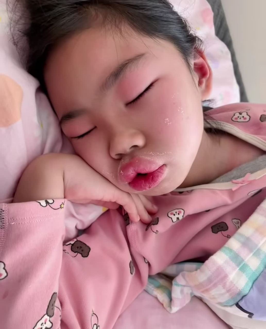 侄女阳痿后嘴巴肿了![大笑][大笑]#搞笑