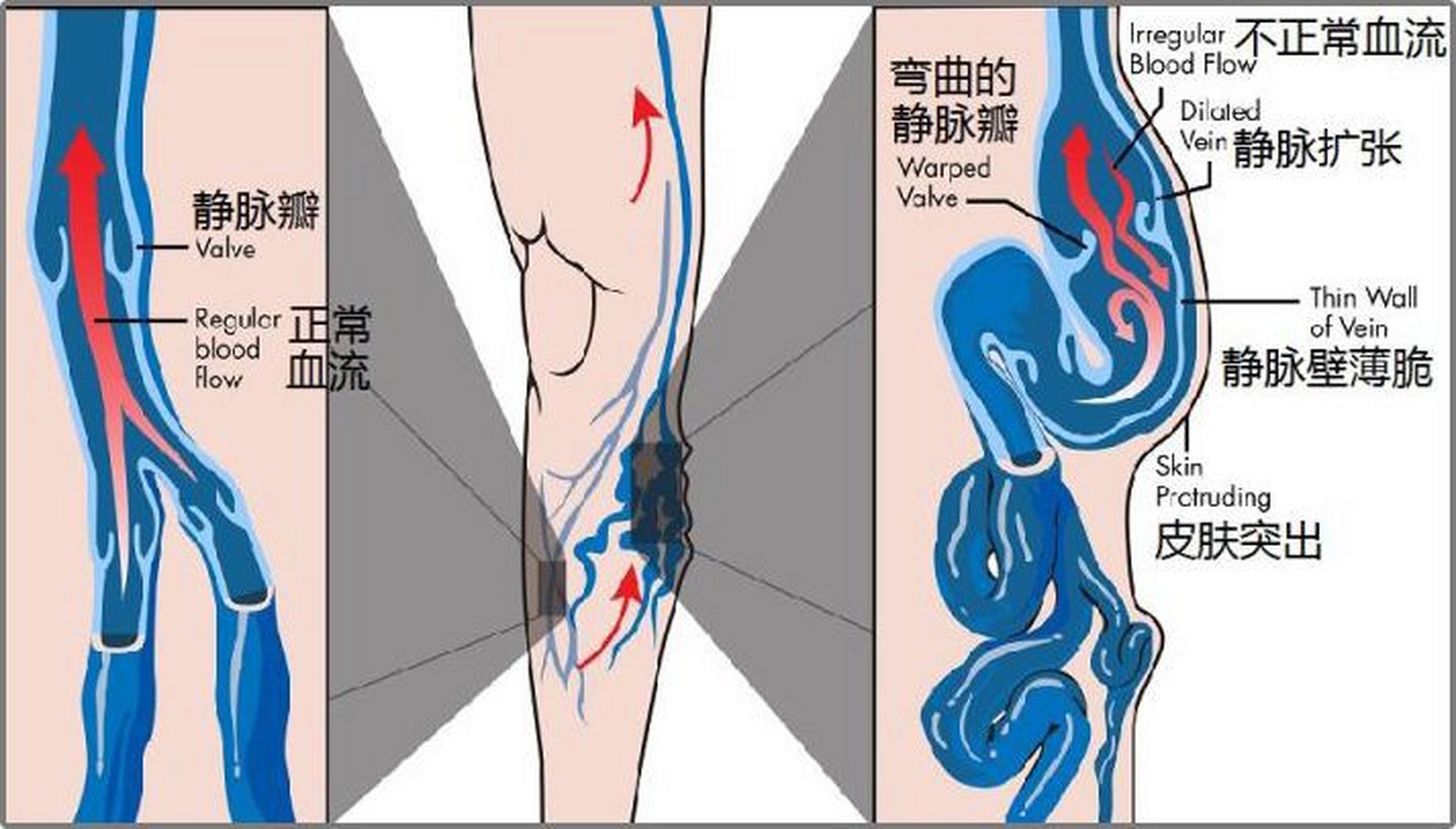 静脉瓣作用图片