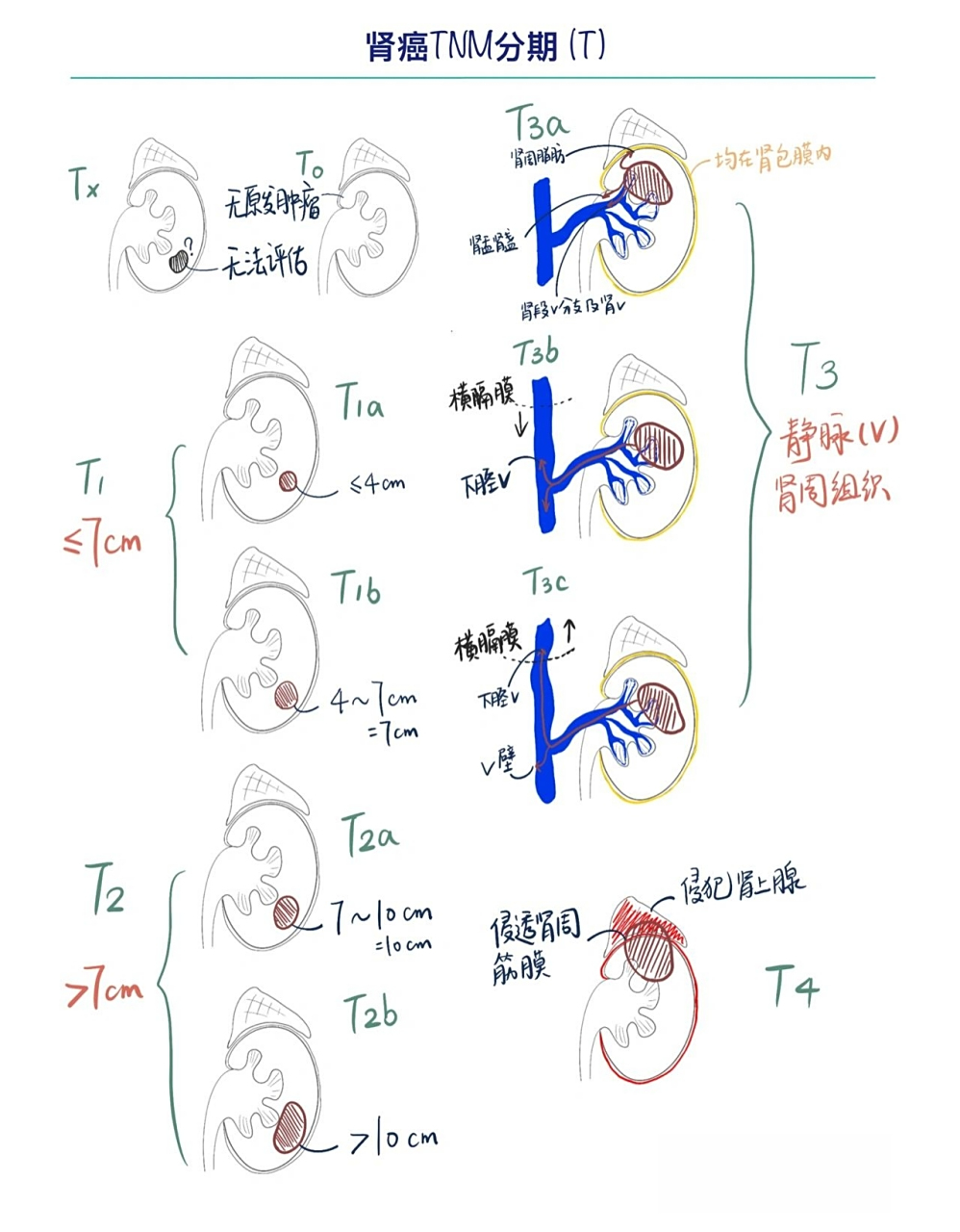 tnm分期是判断肾癌临床分期重要的参考 t1,t2分别是i期,ii期 (早期)
