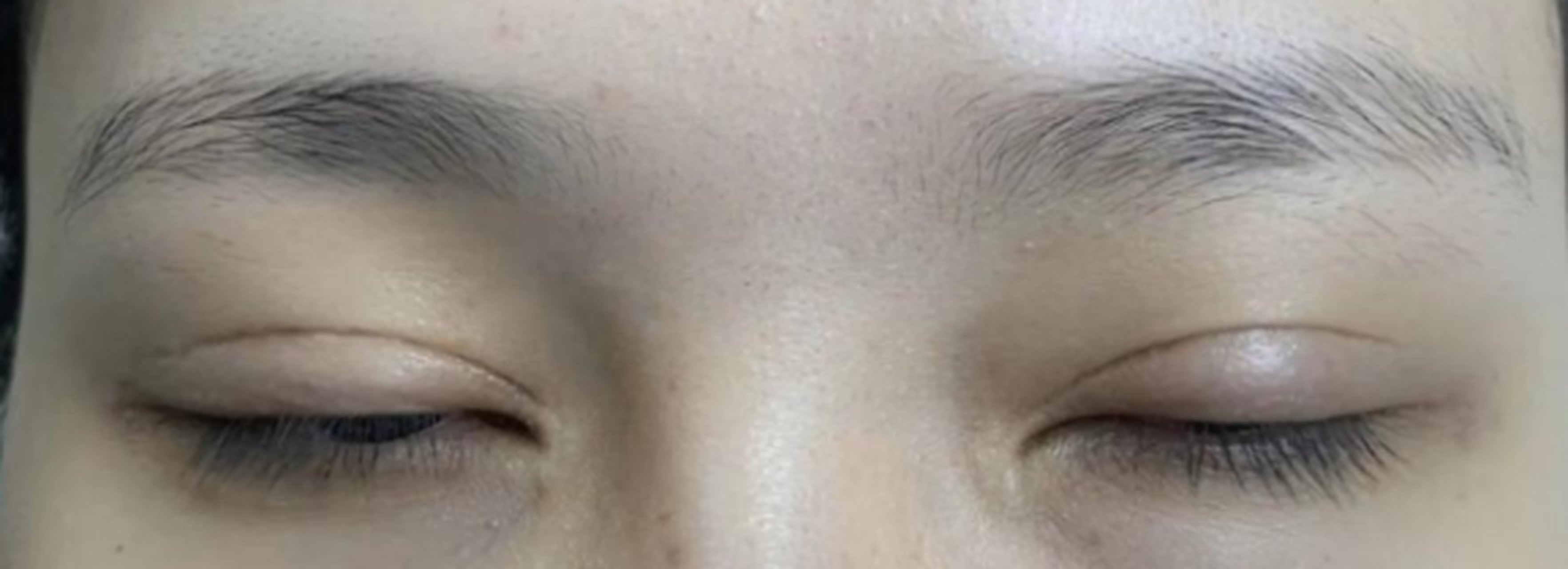 为什么做完双眼皮后,闭眼疤痕会很明显? 可能是这三个原因,注意了!