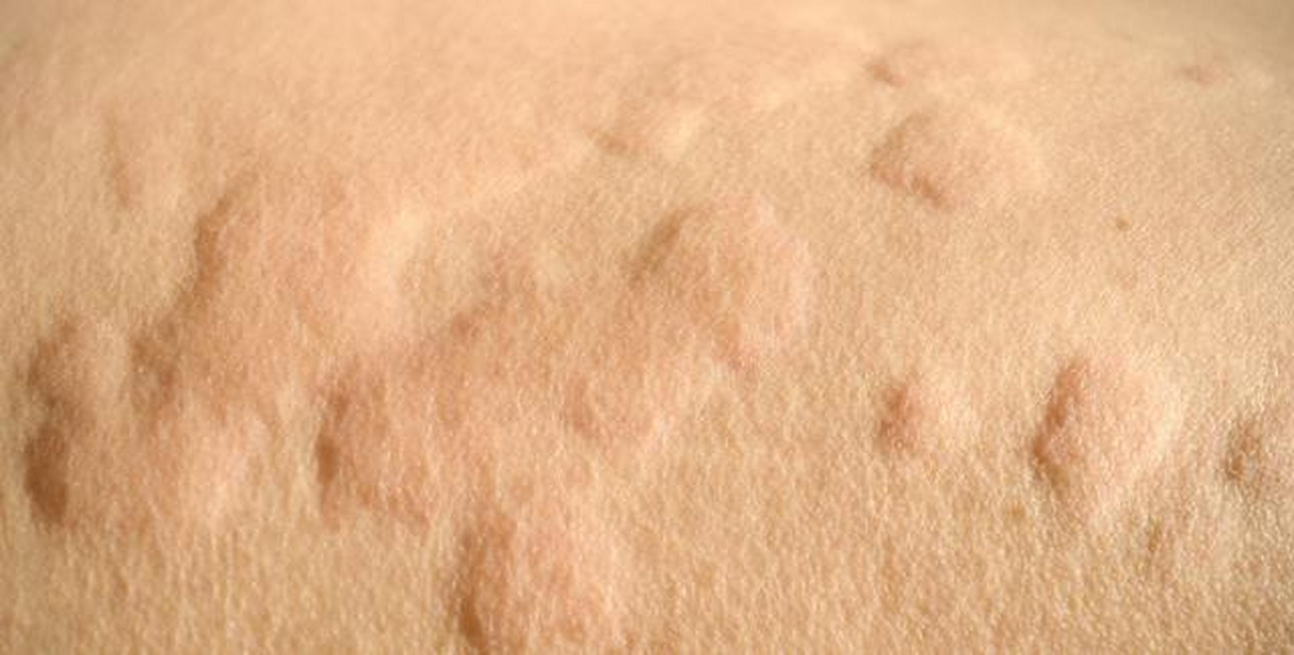 这些苍白或红色风团常会当天消退,有些几十分钟就没有踪影了.