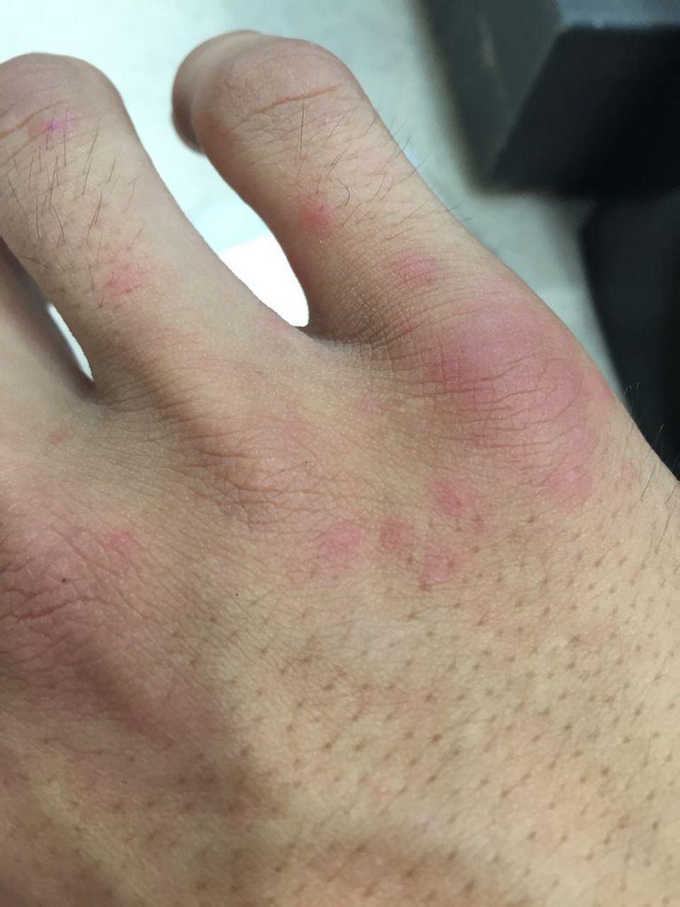 最近有粉丝私信问:她一戴乳胶手套就过敏起疹子,怎么办呀?