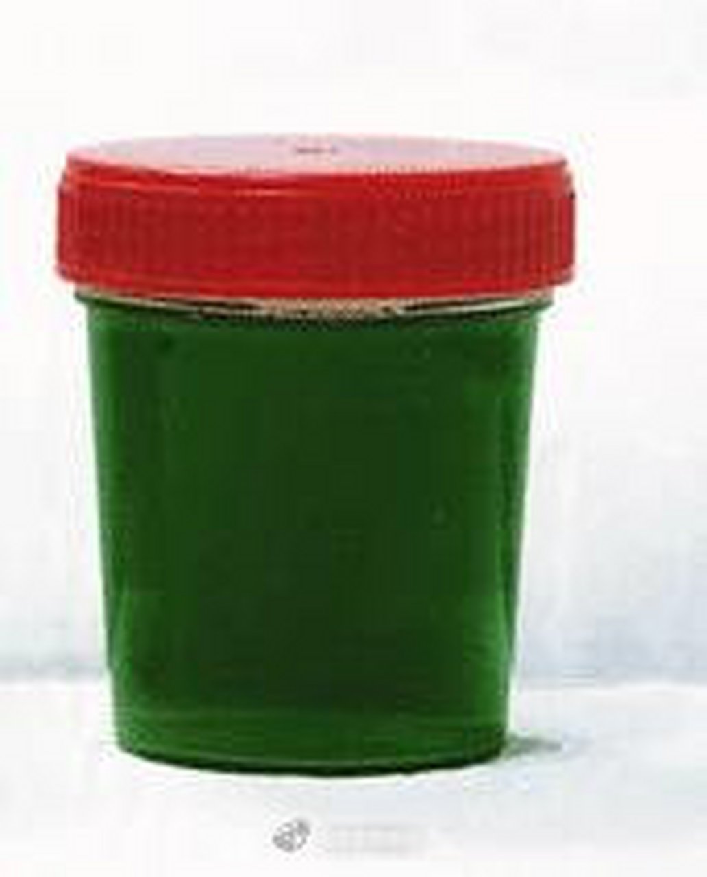 绿色尿液:尿液中有绿脓杆菌滋生时,或胆红素尿放置过久,氧化成