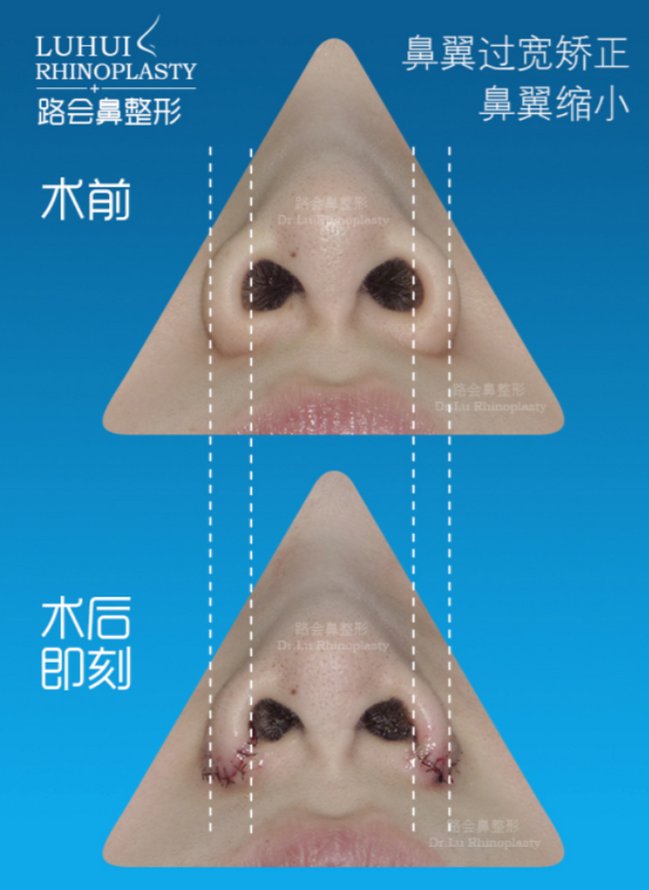 鼻翼缩小手术切口在哪里?会留疤吗?