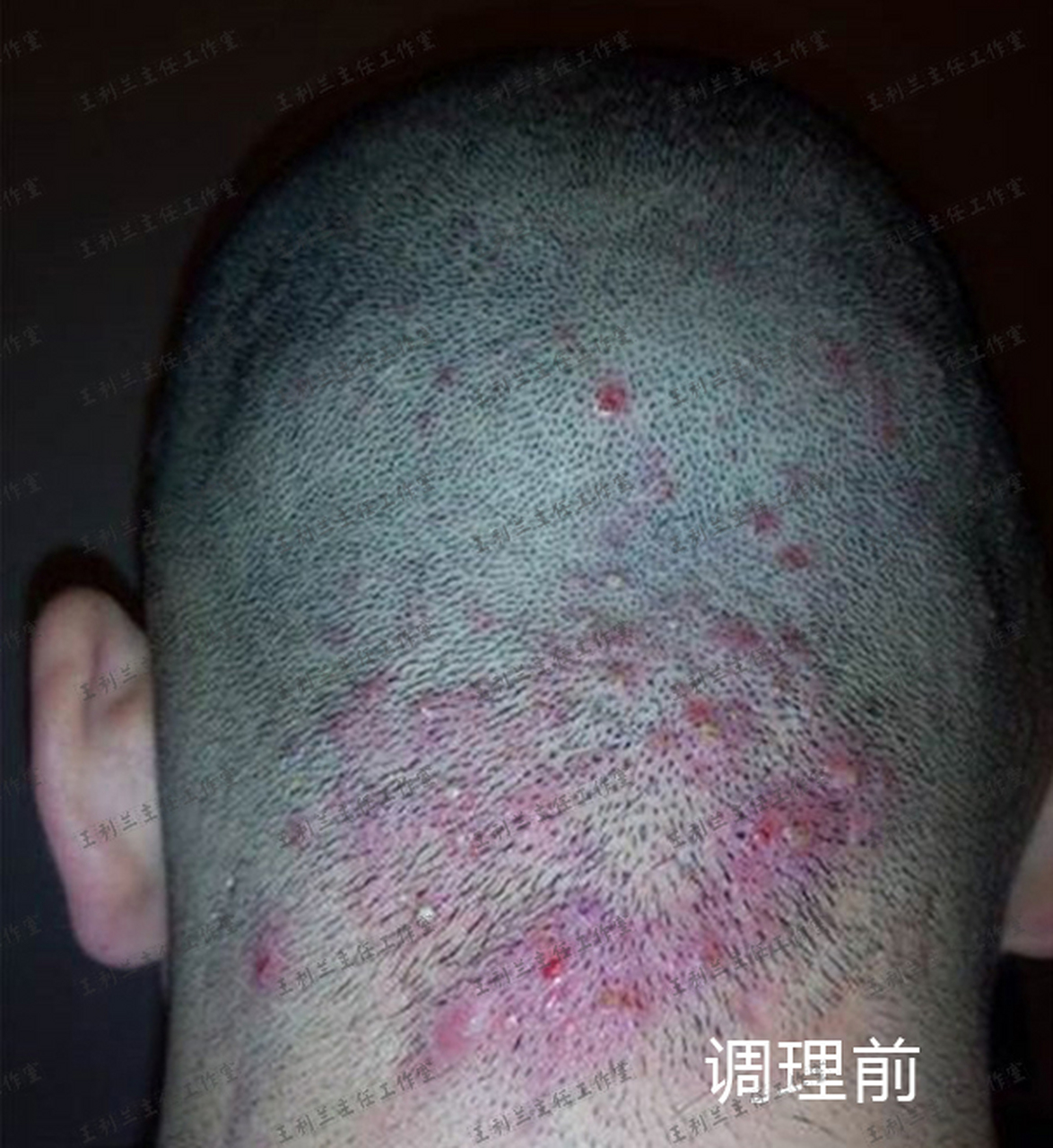 头上毛囊炎疙瘩又疼又痒,中医1个方子帮改善!