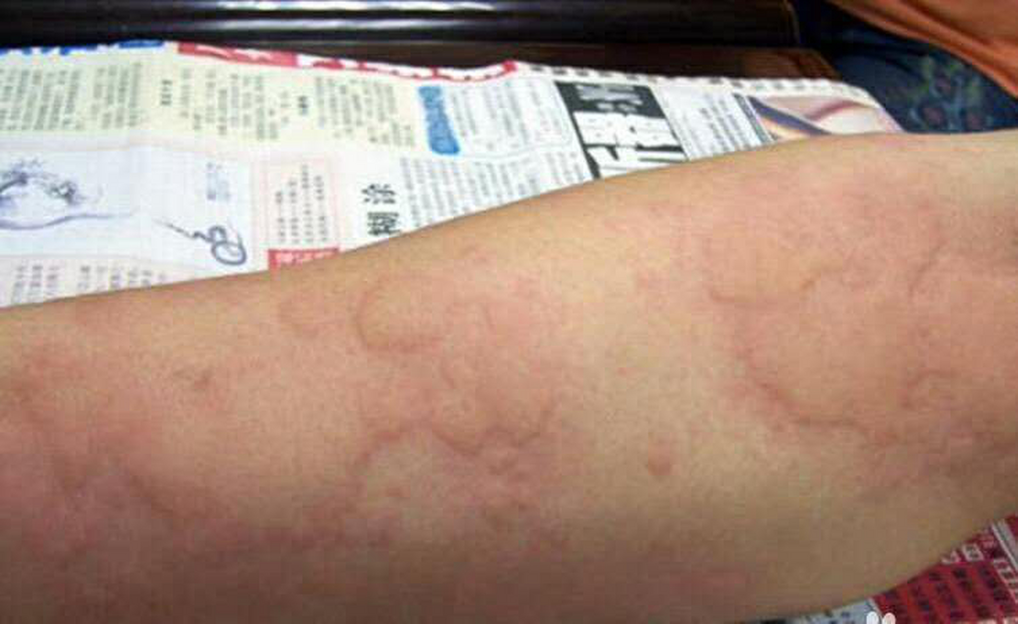 血热型荨麻疹是一种血管反应性皮肤病,临床以皮肤与粘膜