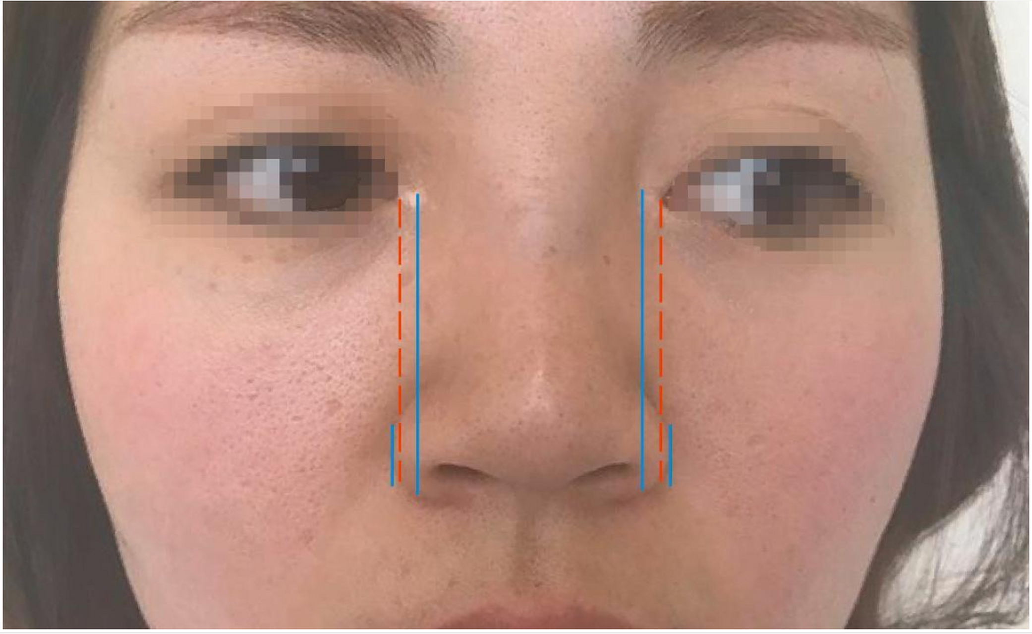 宽鼻做鼻骨内推会反弹吗?
