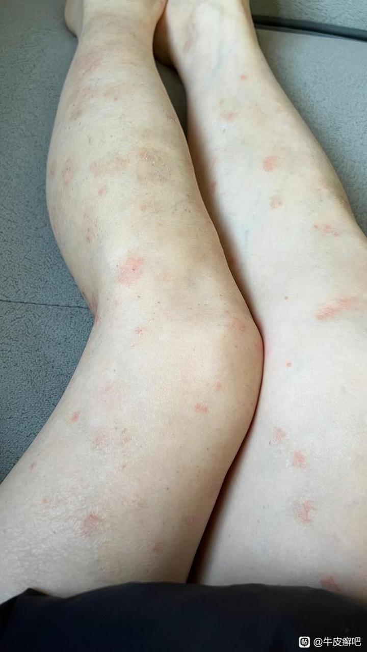 左右双腿都有牛皮癣,1个月以后,皮损消失不见了 究竟是怎么做到的
