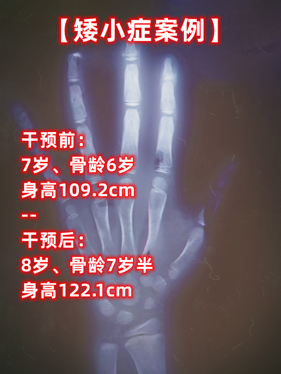 【矮小症案例】今年3月接诊的一个男孩,当时情况很不乐观.