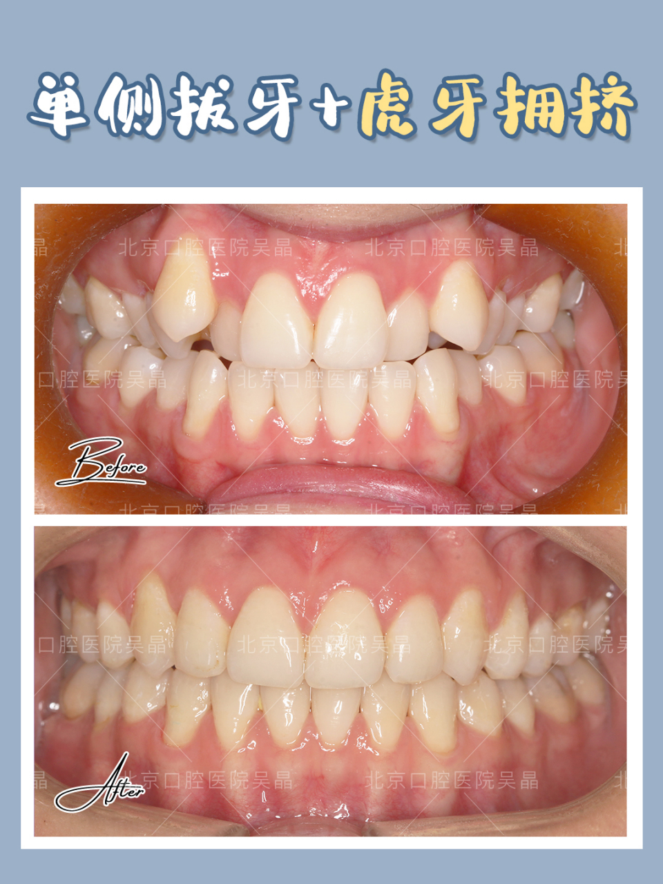 正畸##牙齿矫正#  隐适美单侧拔牙改善虎牙拥挤
