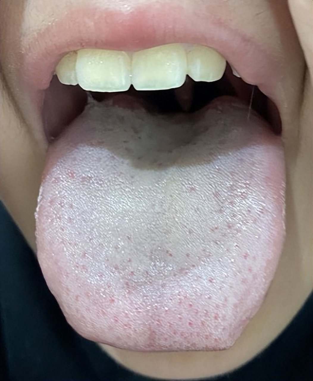 舌苔发白,厚腻无解?