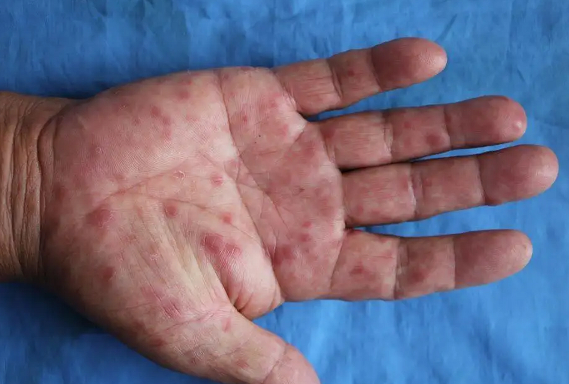 74岁老伯,好多年没有性生活了,最近几个月,他的