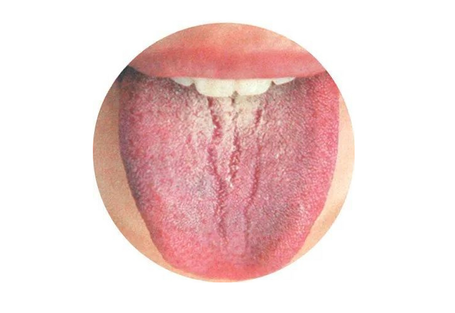 关于舌头中间裂纹的问题,主要有以下几种情况:阴虚血亏,肾阴不足,心血