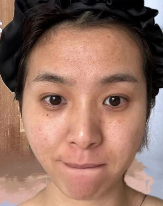 额头黑色素沉淀是由于皮肤在暴.@一禅健康笔记的动态