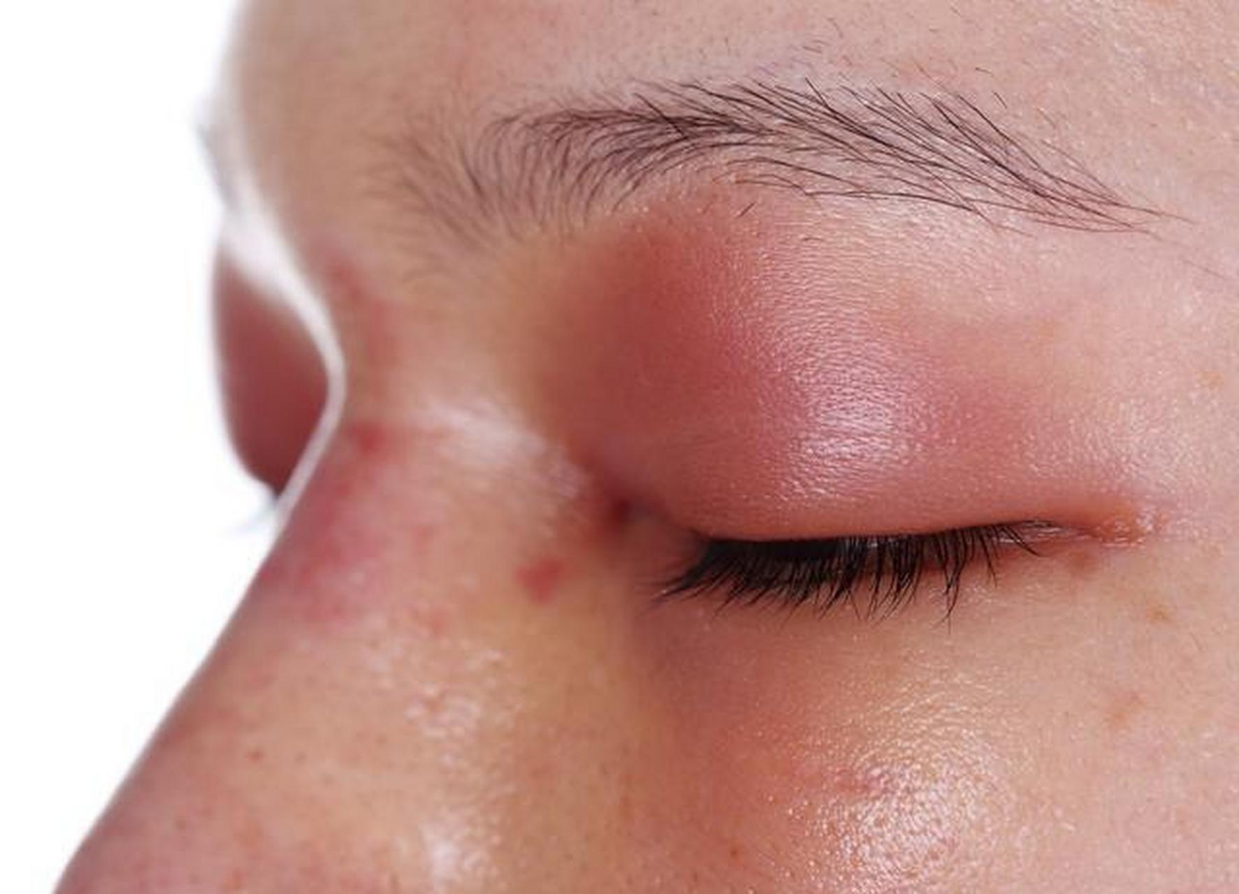 五个征兆可能是肾炎 一,眼睑浮肿 如果早晨起来眼睑或面部,出现浮肿