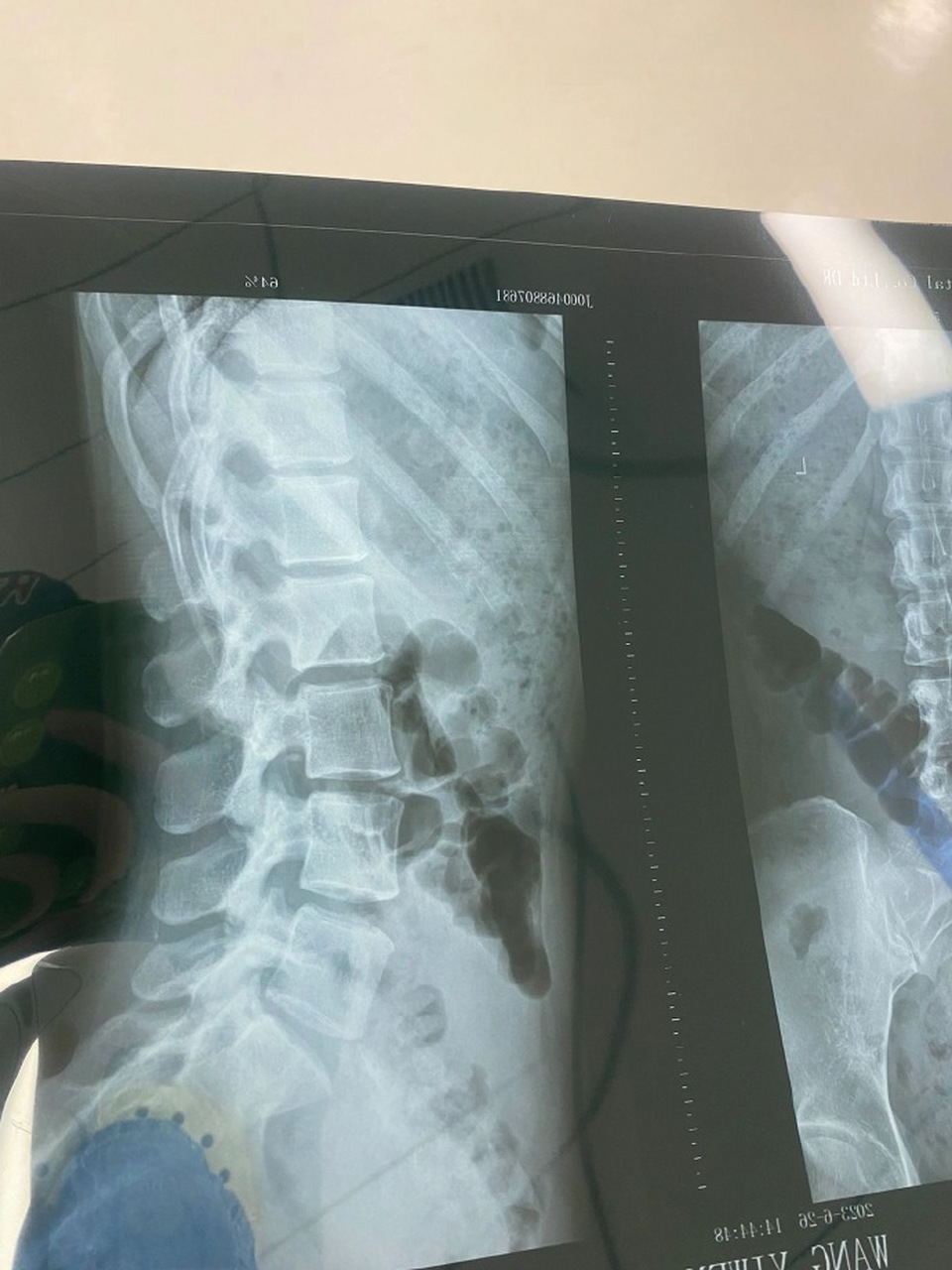 好尴尬[啊][啊]  拍ct之前记得上个厕所#搞笑