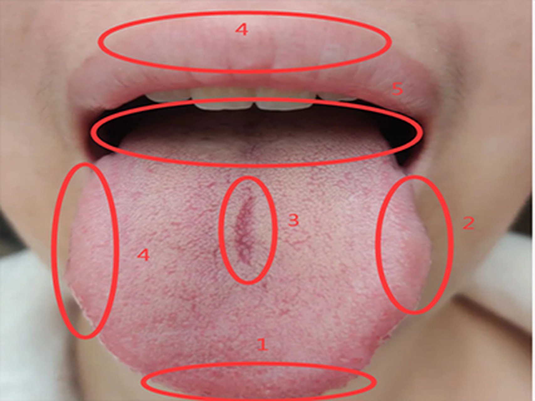 胆结石舌苔图片图片