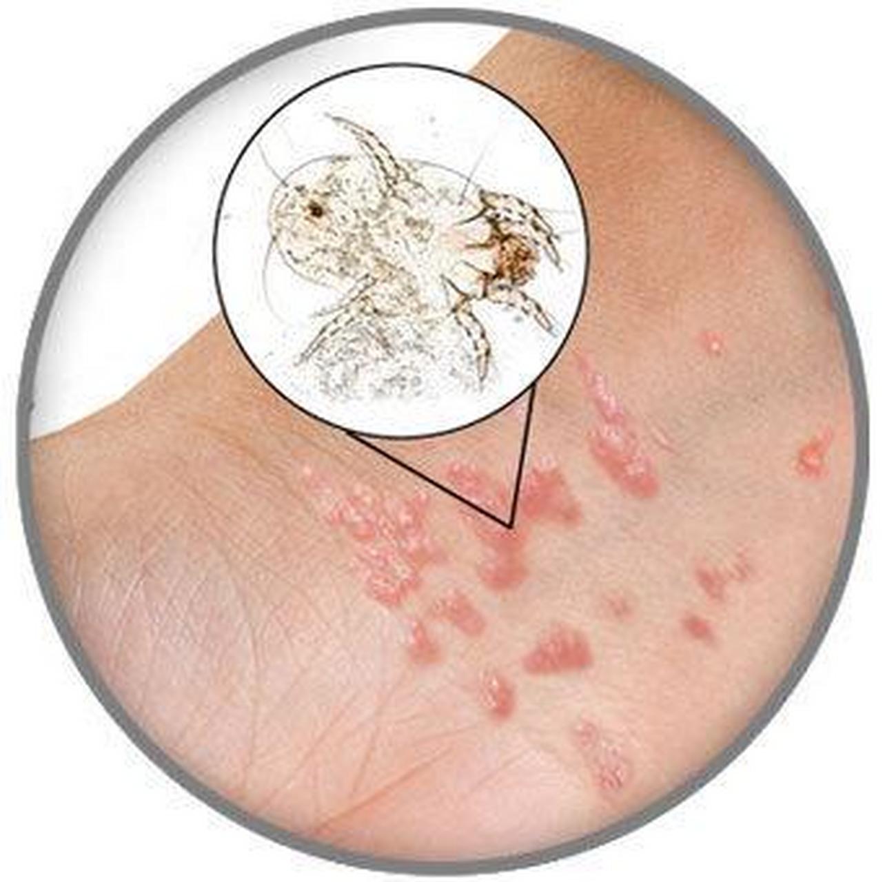 疥疮# #赣州皮肤科医院# 疥疮是由疥螨感染人体,所导致的一种寄生虫