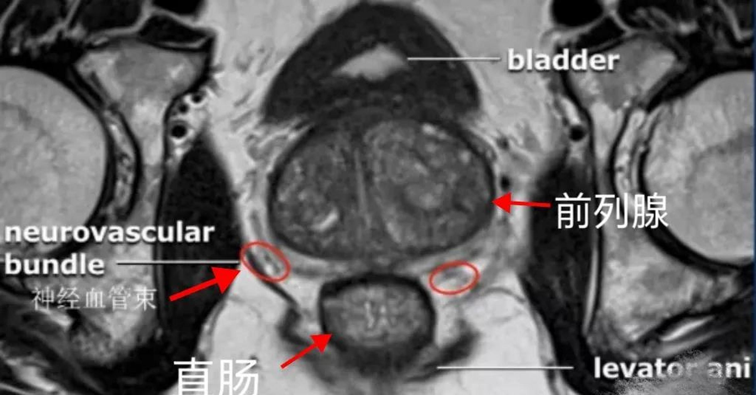 我们先看解剖图(图1),前列腺两侧有控制勃起功能的神经血管束,这些