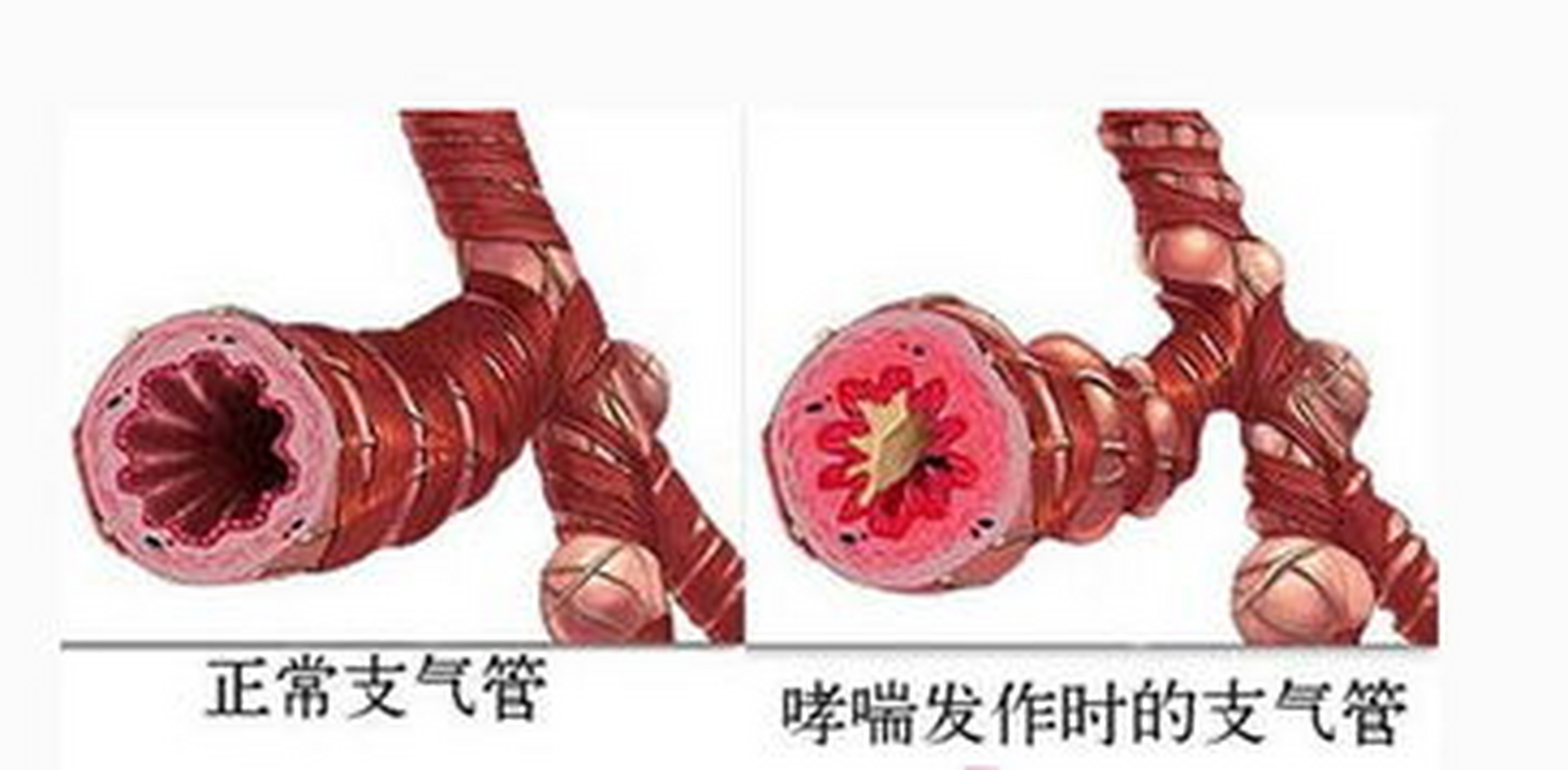 支气管哮喘的特点,你占了几条?