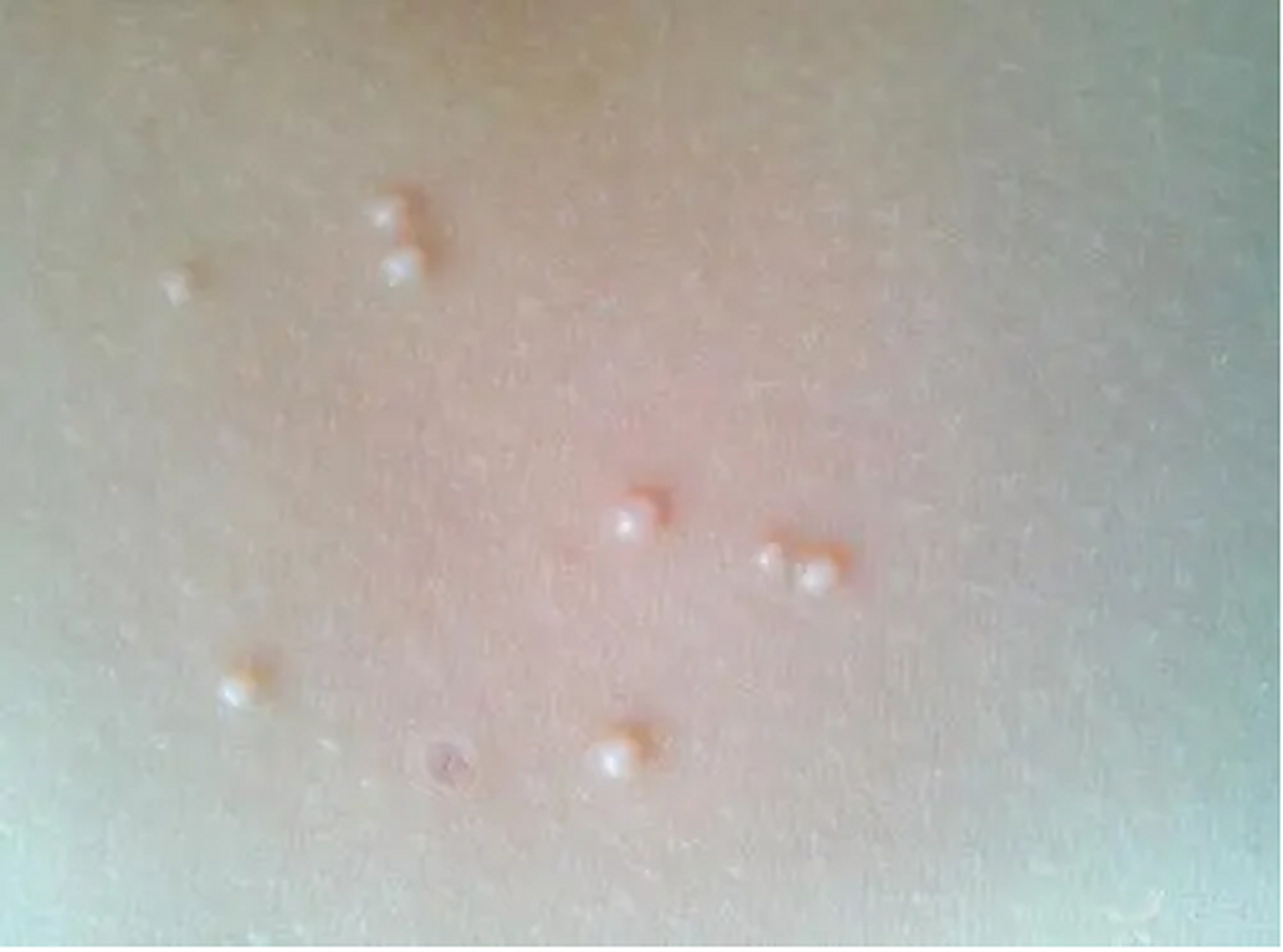 夏季带孩子外出游泳时要注意警惕传染性软疣!