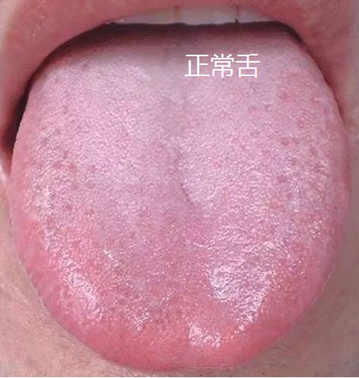 健康人的舌苔图片正常图片