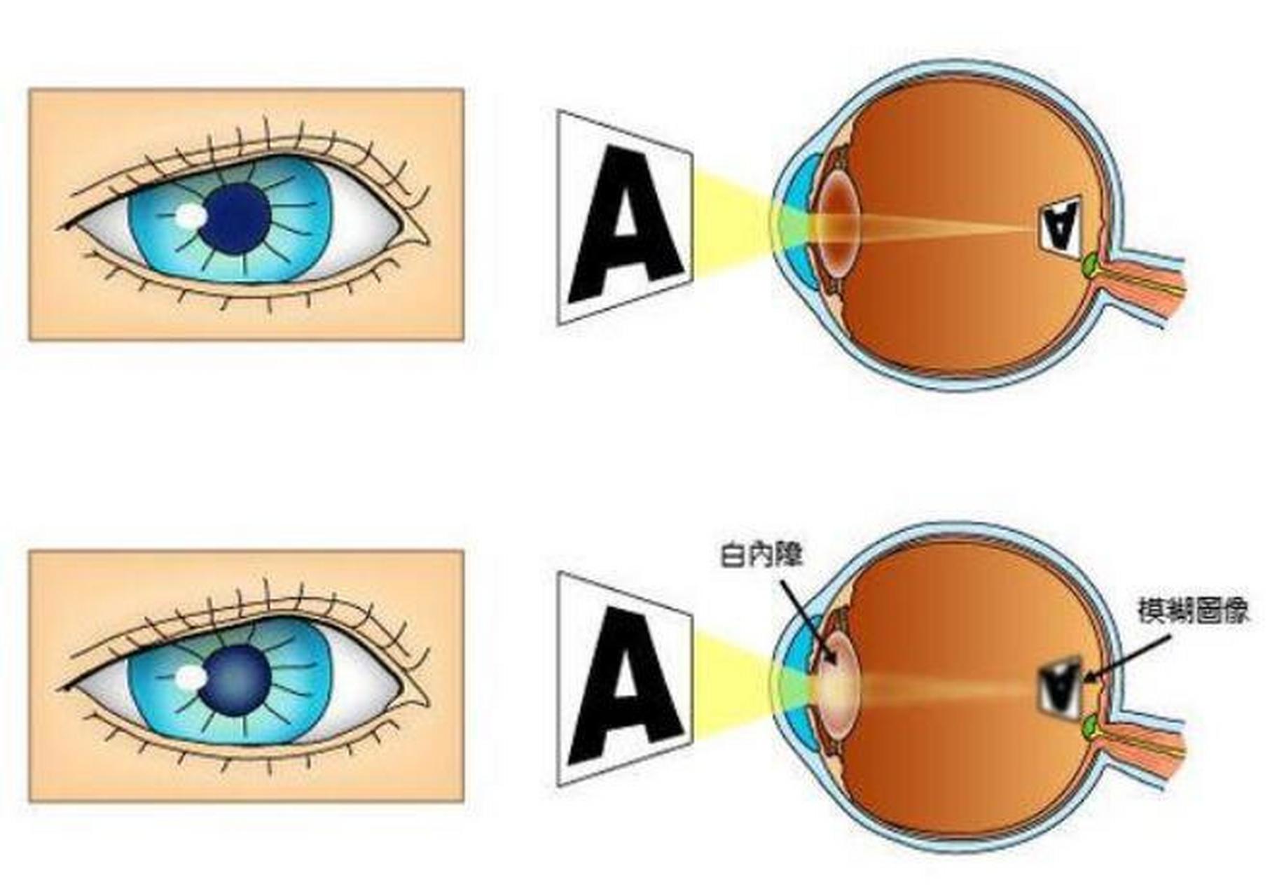 白内障自测图年轻人图片