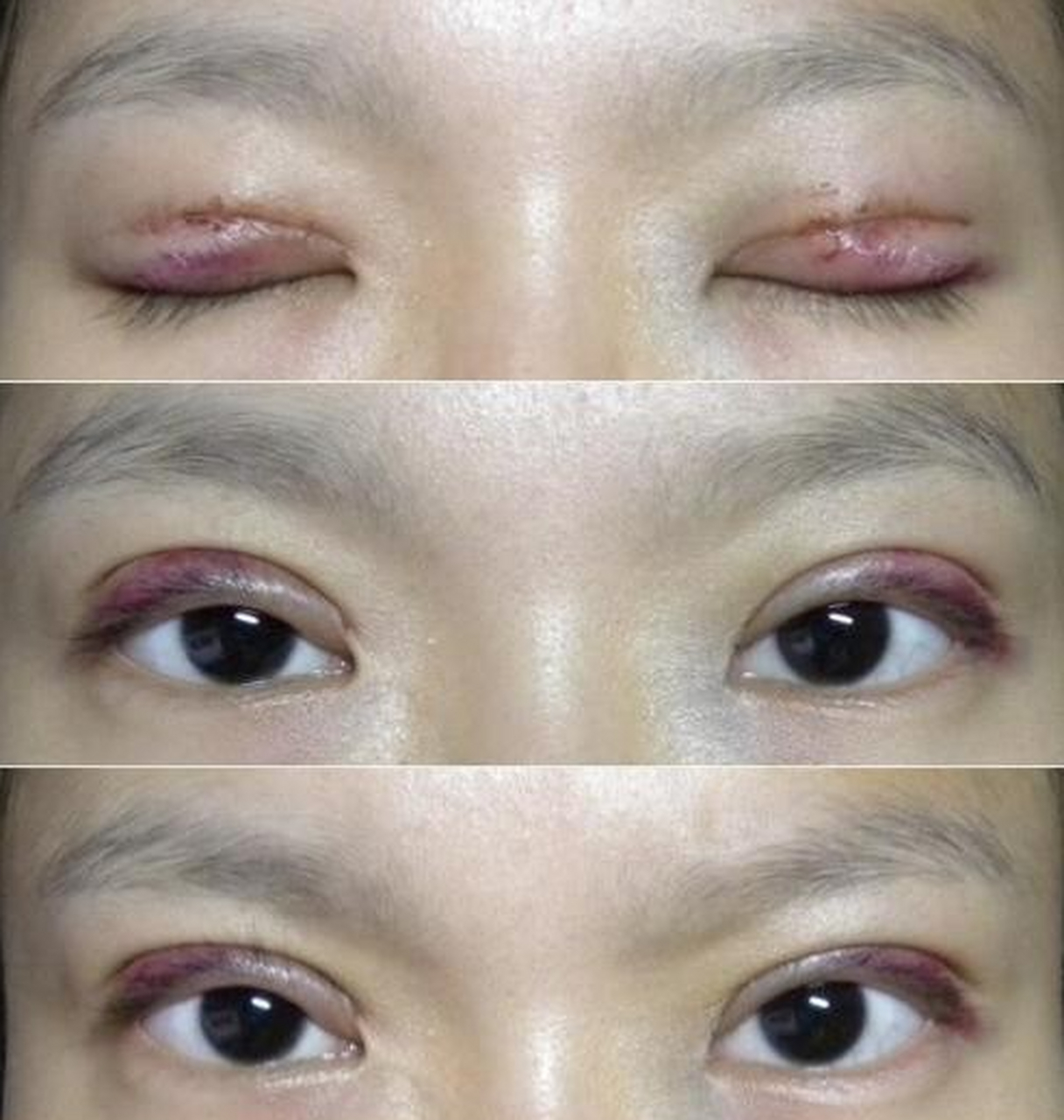 埋线双眼皮通过埋植线材形成褶皱产生双眼皮,不开刀,所以适合眼部