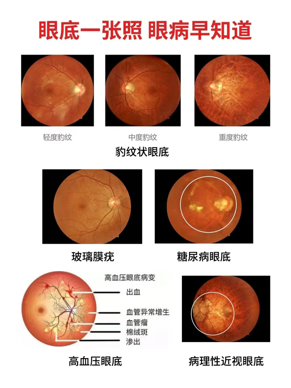 眼底检查是一种非常重要的眼科检查,它可以检测眼底的各种病变,如视网