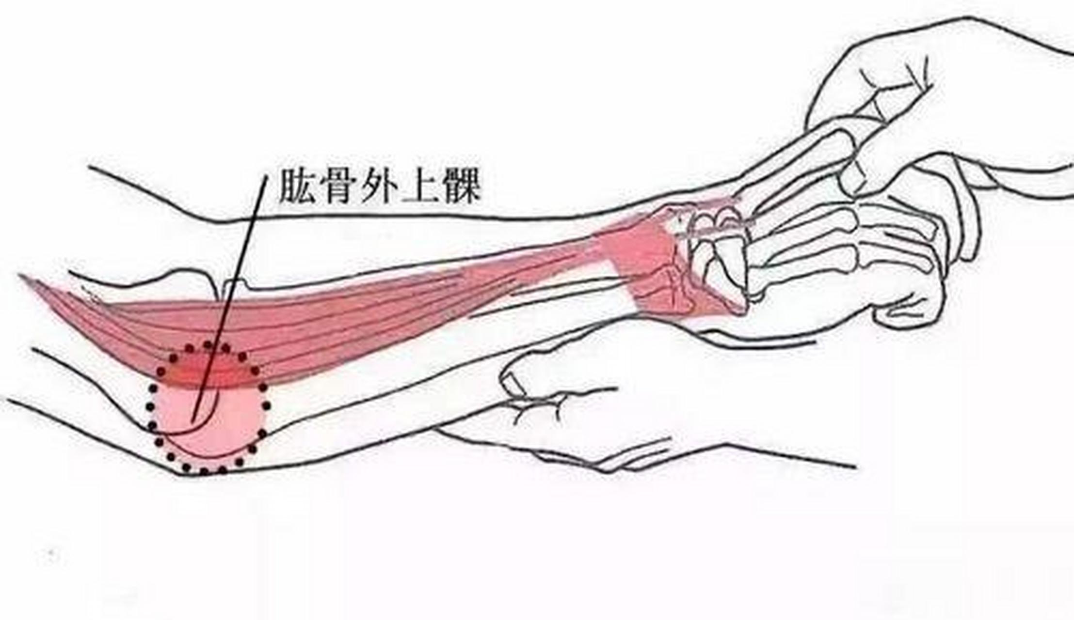 肘关节外侧疼痛的原因图片