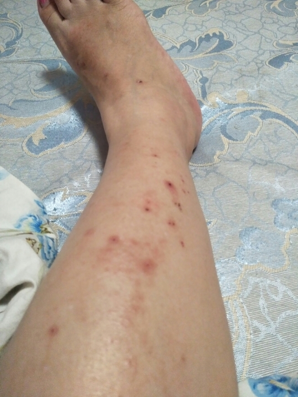 身体2个部位瘙痒,或许是糖尿病"信号",别以为是皮肤病  现在患糖尿病