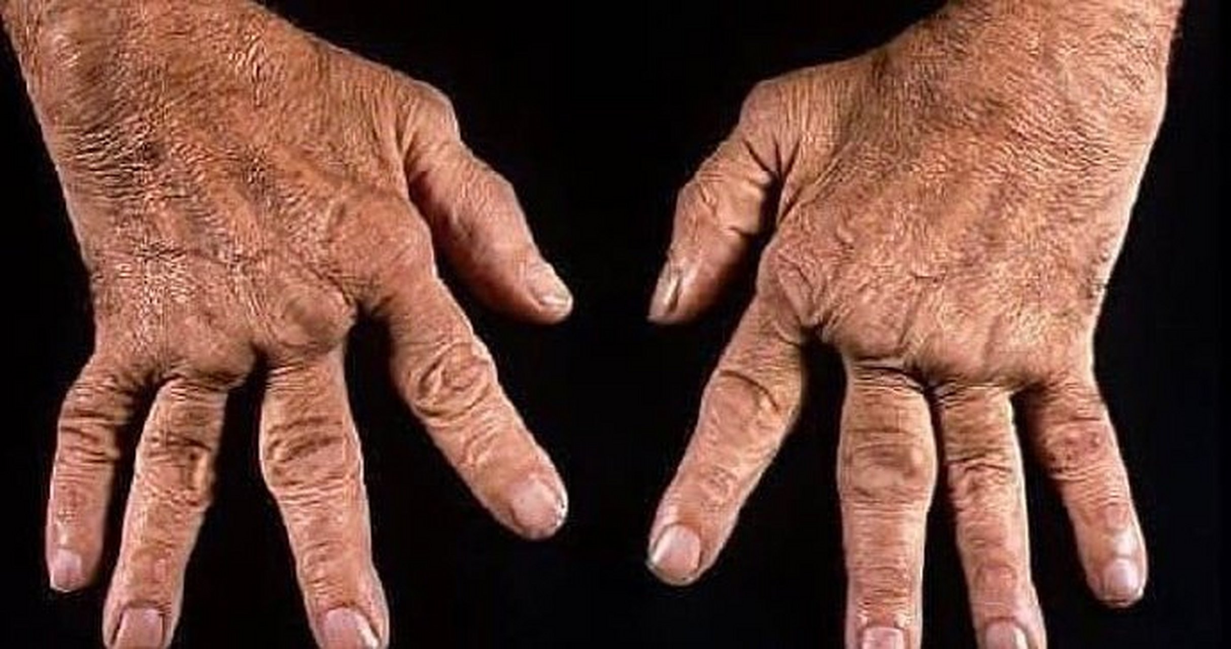 类风湿天鹅颈 67676767[05]