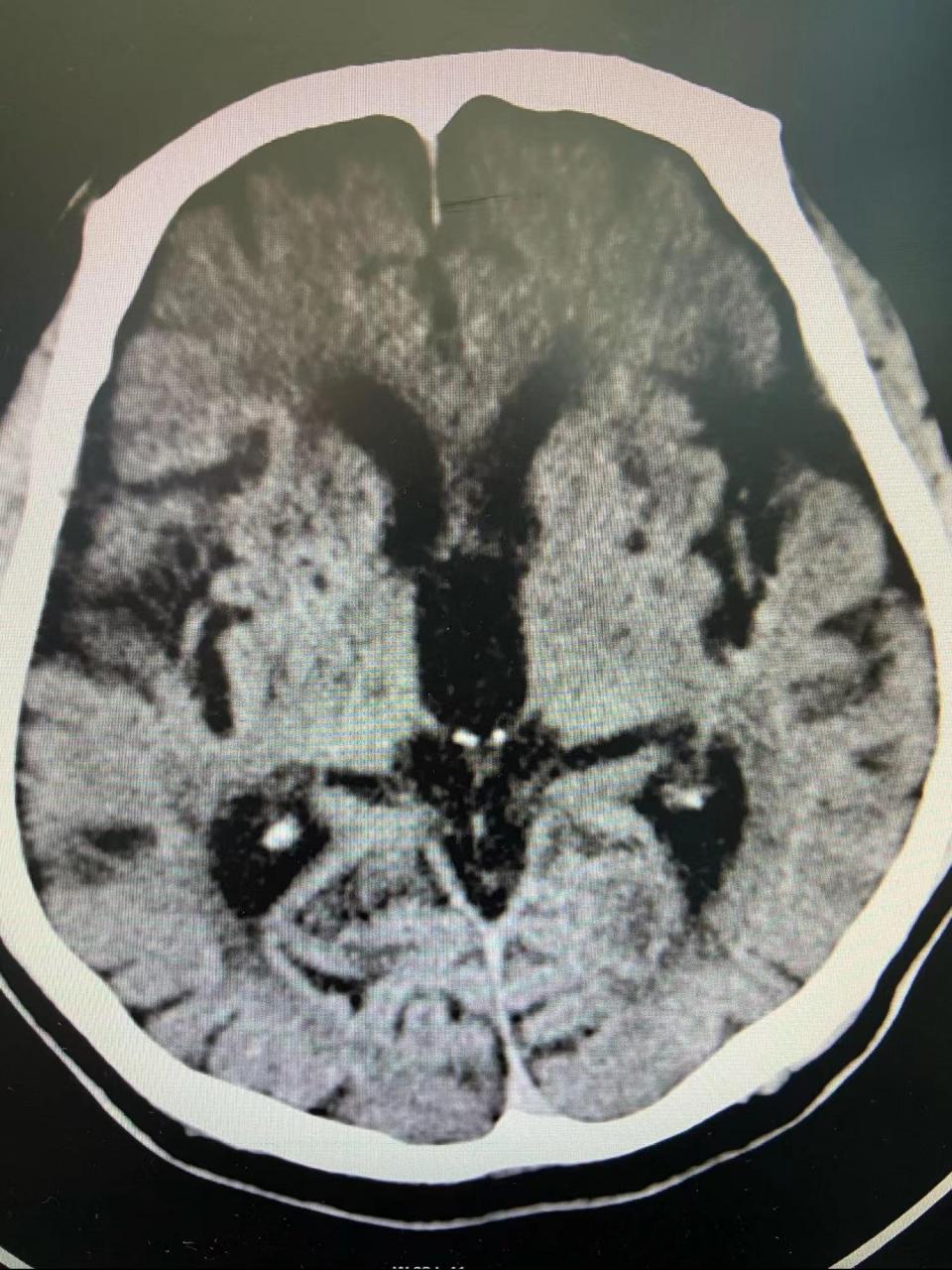 脑微出血,长期高血压,痴呆后,ct提示脑梗塞; mr提示多发脑梗塞合并