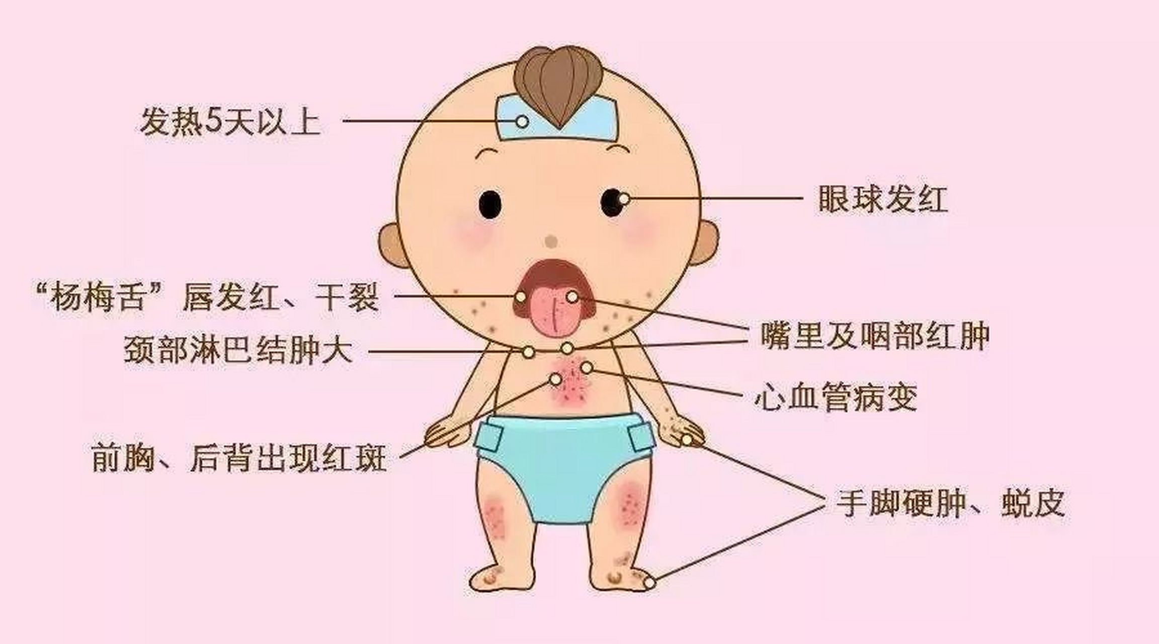 【猩红热症状有哪些】