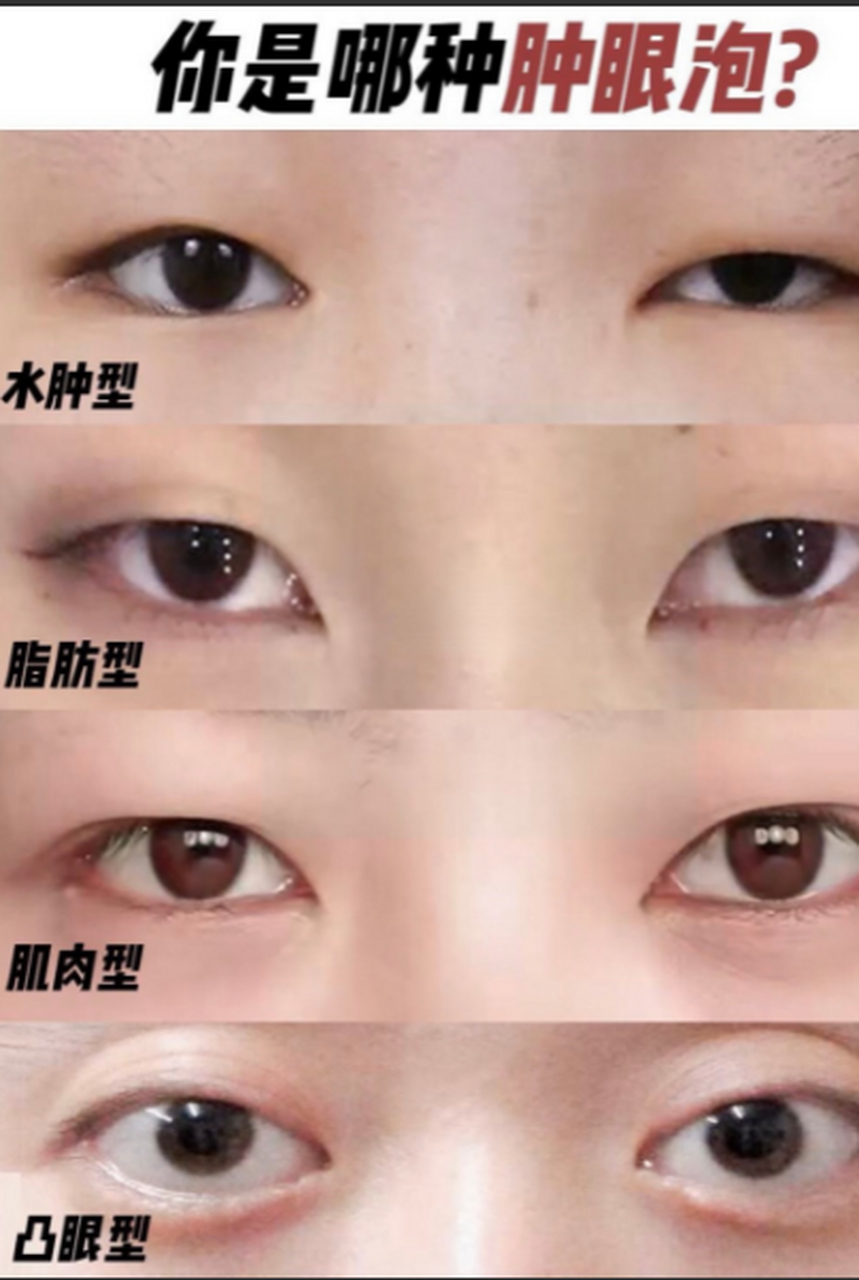 肿眼泡可以只抽脂不割双眼皮吗?