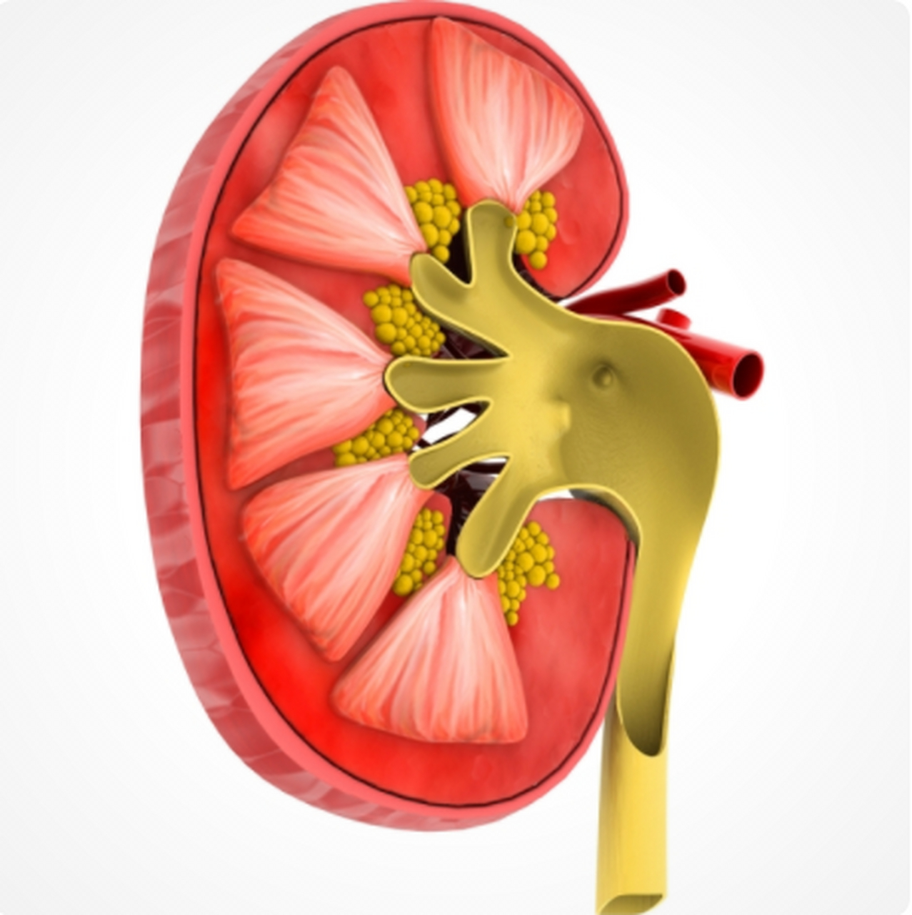 疼痛时还伴发血尿的肾结石患者,继发急性肾盂肾炎或者是肾机能的时候