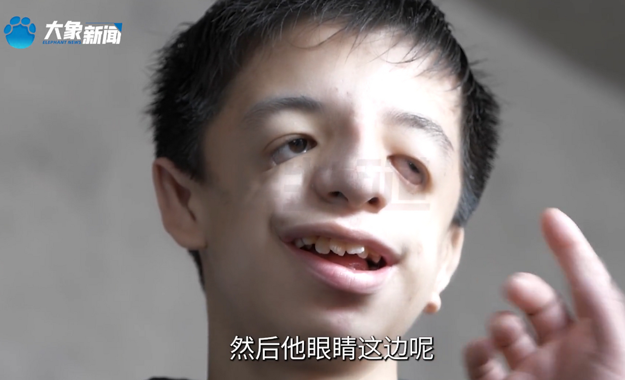 男孩患"鸟面综合症",脸部看起来像鸟,妈妈:小孩看到他都害怕