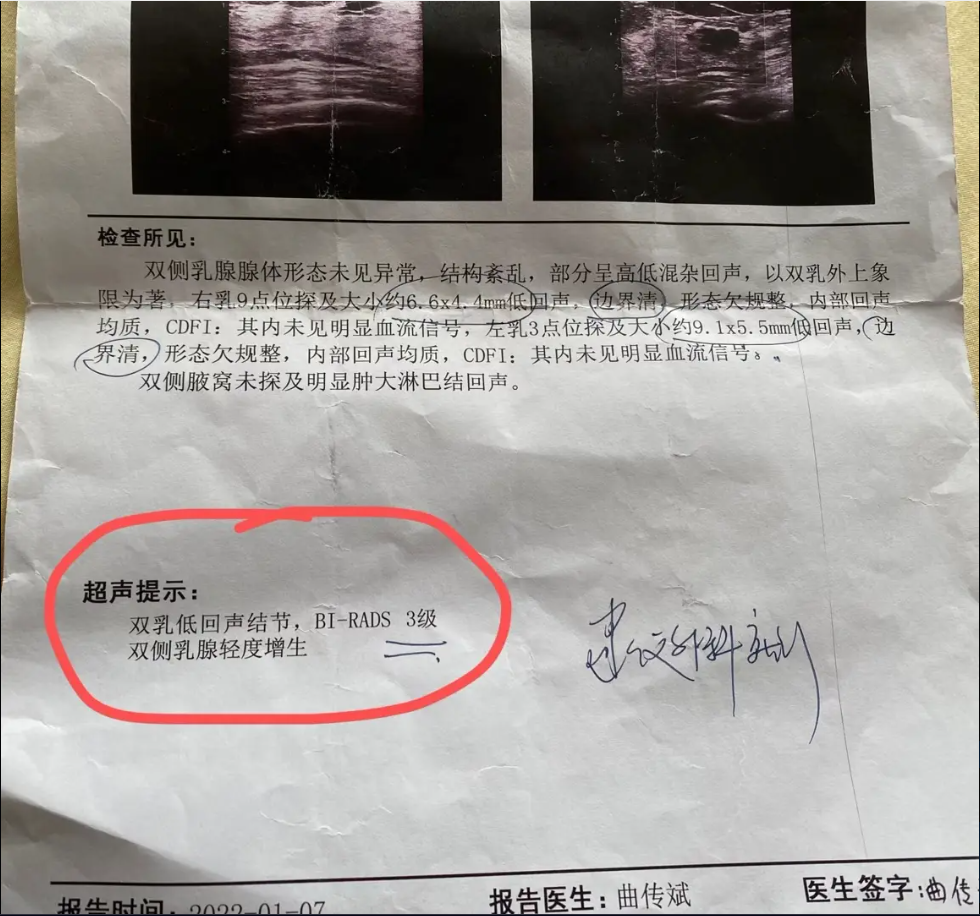 图片和正常图片乳腺结节4a乳房结节图片真实图片乳腺结节恶性的图片